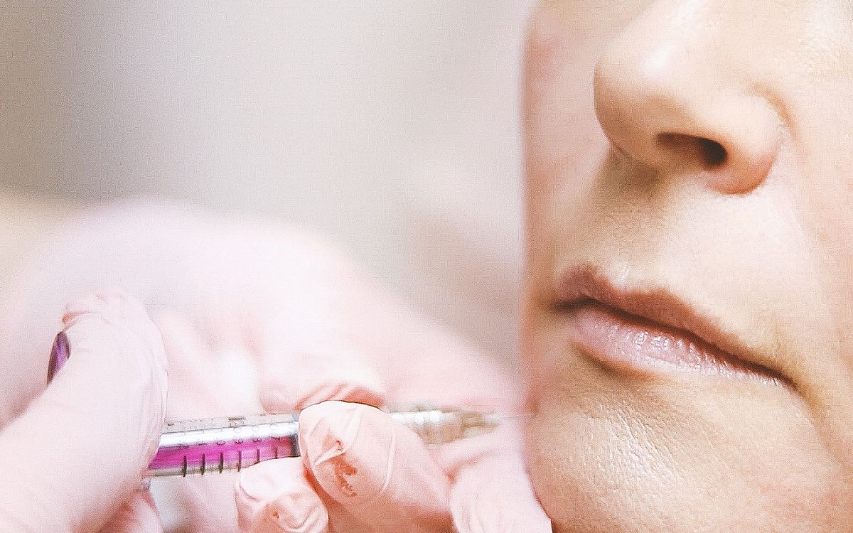 Preenchimento labial com ácido hialurônico